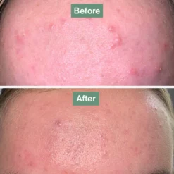 Beauty Bundle -Tv Cabinet Store skinsaviourbefore after